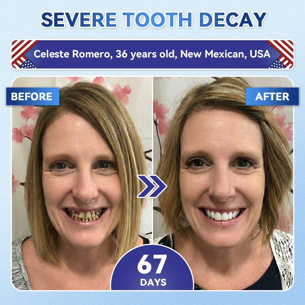 QIAWI® 🦷 Tideglusib Fast‑Dissolving Tooth & Gum Repair Oral Strips 😁 (Supports tooth repair and helps relieve gum discomfort and other common oral concerns)